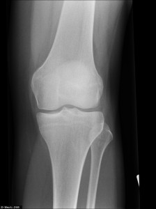Röntgenbild eines Kniegelenkes